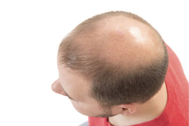 ¿Qué es alopecia?