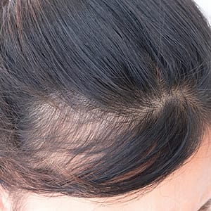 alopecia-en-mujeres
