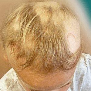alopecia-en-ninos