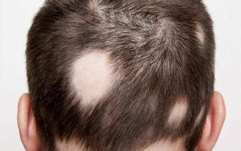 ¿Qué es la alopecia areata?