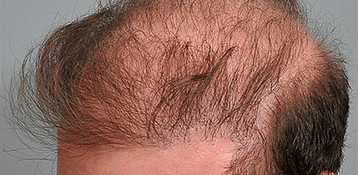 poca-densidad-en-nicroinjertos-de-cabello-mal-realizados