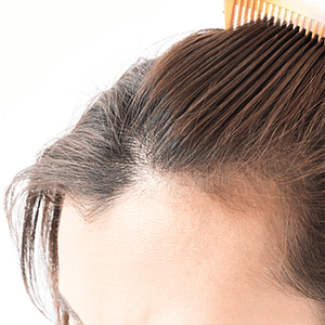 alopecia-en-mujeres-mexicanas